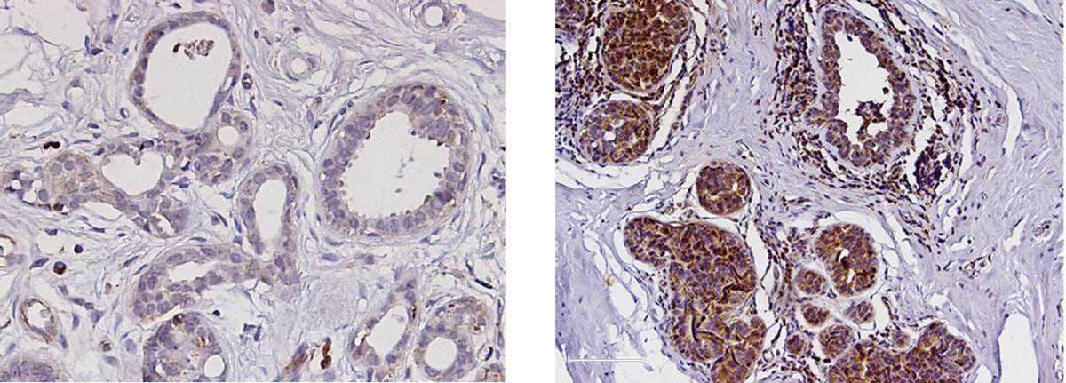 Levels of the PYK2 enzyme (brown) are low in normal breast tissue (left) and very high in an advanced breast cancer tumor (right)