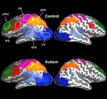 As compared to the control brain (top), the autistic brain (bottom) shows weaker inter-hemispheric synchronization in several areas, particularly the superior temporal gyrus (light blue) and the inferior frontal gyrus (red)