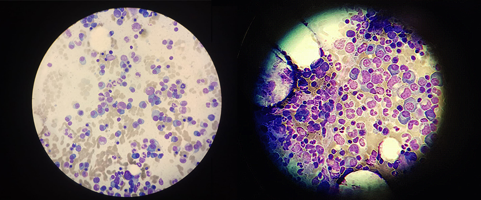 Resistant multiple myeloma cells (violet-blue) in two samples, seen under a microscope