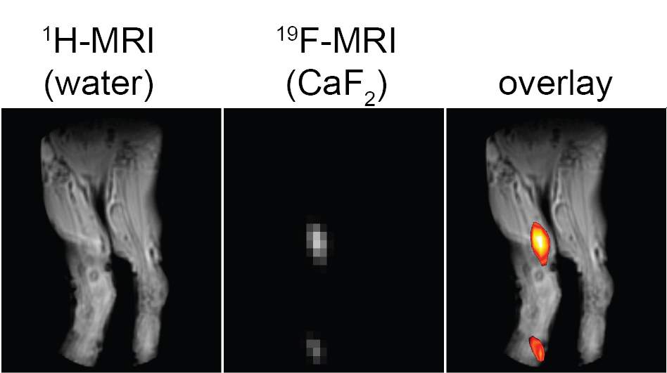 MRI using calcium fluoride as a tracer picks up inflammation that regular imaging does not detect 