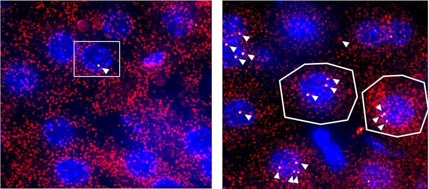 Fluorescence microscope snapshots of mouse liver tissue revealing new mRNA, an indicator of gene activity (bright dots marked by white triangles). The lone new mRNA (left) indicates that its gene operates only in infrequent bursts; in contrast, the presence of numerous new mRNAs (right) suggests gene activity that proceeds in long, frequent bursts