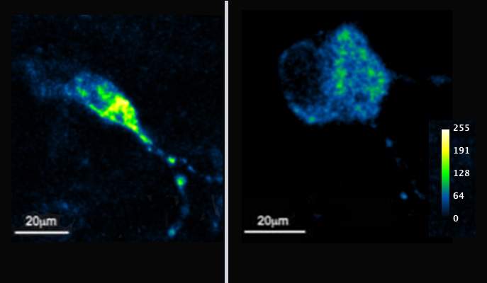 Left: normal nerve cells; right cells genetically engineered to neutralize MTCH2. Fluorescent proteins reveal the calcium uptake in the mitochondria of these cells. The genetically engineered cells reveal dramatically less calcium uptake – evidence of the crucial role this gene plays in mitochondria function