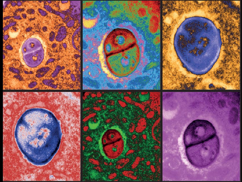 Digitally colored electron microscopy images of melanoma cells harboring bacteria