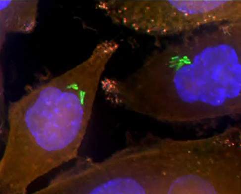  Bacteria (green) inside human pancreatic cancer cells (AsPC1 cells). The cells’ nuclei are stained blue while their cytoplasm is stained orange