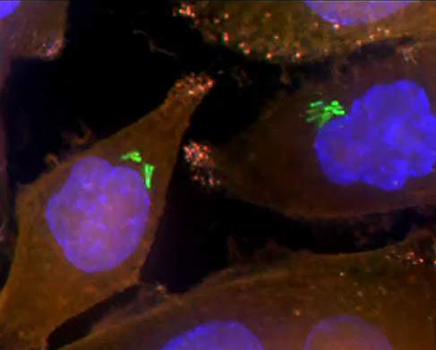  Bacteria (green) inside human pancreatic cancer cells (AsPC1 cells). The cells’ nuclei are stained blue while their cytoplasm is stained orange
