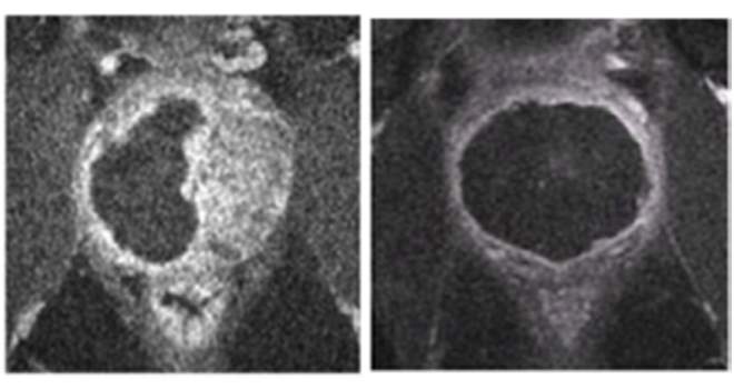 Magnetic resonance images of the prostate gland after treatment with Tookad Soluble. The black regions show the portions of the prostate that have been eliminated to remove the previously detected cancerous tissue 