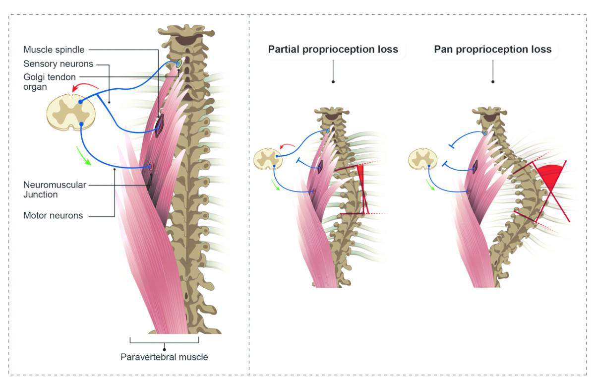 scoliosis formation
