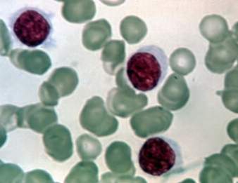  Leukemia cells. Image: Wikimedia commons, NIH