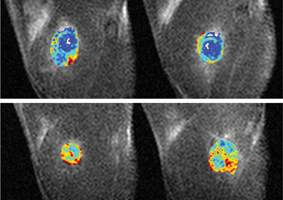 MRI image: High levels of Ferritin show up in red, low levels in blue