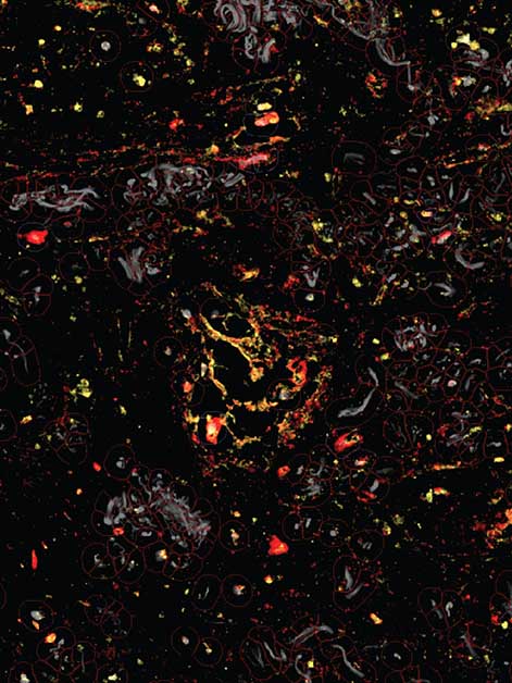 Human lung cancer tissue under a microscope. The enzymes (yellow) that unmask the immune-activating molecules are found near the TREM2 receptors (red) of the tumor-assisting macrophages. This targeted unmasking can prevent damage to healthy tissues