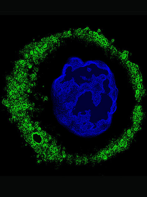 Natural anticancer antibodies (green) bound to a single ovarian tumor cell; the cell’s nucleus is in blue. Viewed with confocal microscopy