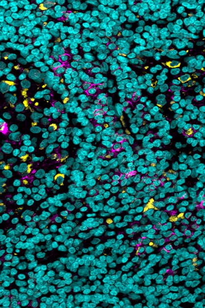 Tissue sample of a particularly aggressive skin cancer reveals immune cells (yellow) that express on their surfaces a “brake pedal” receptor called FcgIIb (purple); cell nuclei are in blue