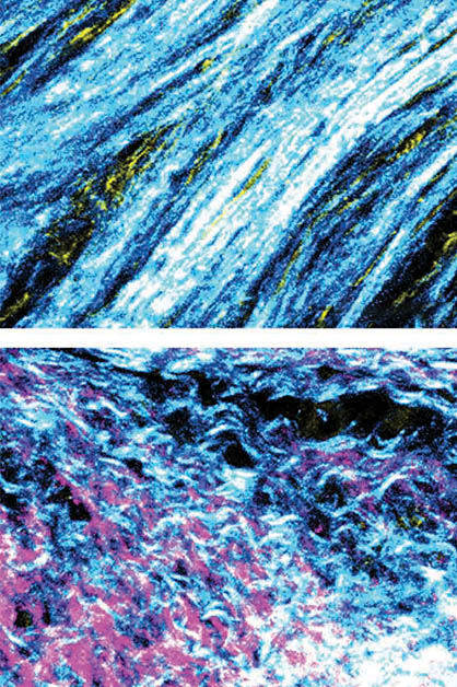 Collagen fibers deposited by fibroblasts in the tumor microenvironment, viewed under a microscope. The fibers form an orderly pattern in tumors with an unmutated BRCA gene (top); in contrast, in tumors of patients harboring BRCA mutations (bottom), the collagen structure is disordered
