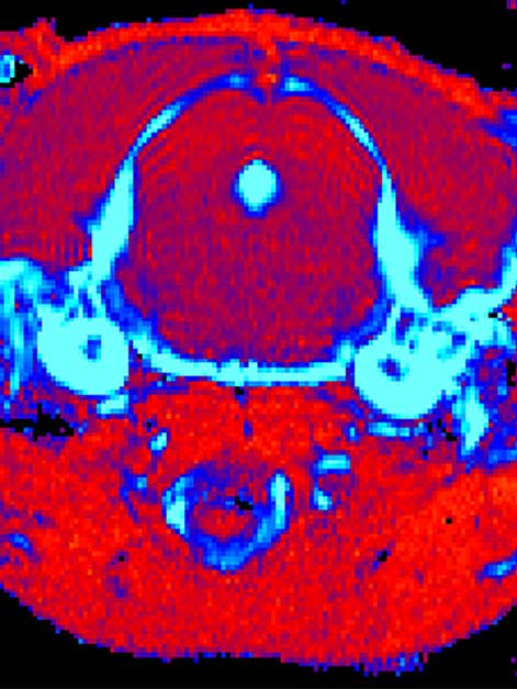 סריקת MRI מוח בעכבר עם מחלת גושה סוג 3 שקיבל טיפול גנטי (מימין) ובעכבר חולה שלא טופל (משמאל). הסריקה חושפת הפחתה משמעותית ברמת הדלקתיות ברקמה (מסומנת בתכלת) בעכבר שטופל 