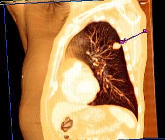 Lung cancer. Image: Lange 123 on Wikimedia commons