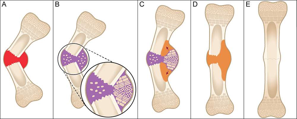 Natural healing process of fractured bones. (A) Healing begins with a collection of blood and inflammation at the fracture site. (B) Soft callus (purple) is formed, which develops into the bidirectional growth plate at the concave side of the fracture site. (C) The growth plate drives bone growth in opposite directions. The result is a jack-like mechanical effect that moves the fragments toward straightening (red arrows). (D) New bone tissue is formed (orange). (E) The shape of the bone is fine-tuned by rem