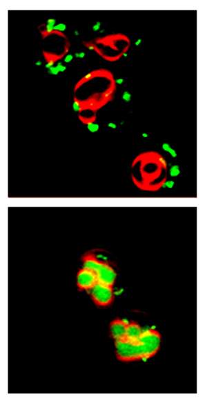  When yeast cells’ nutrition is adequate (top), the cells reveal a normal distribution pattern of Golgi proteins (green dots) outside cellular recycling bodies (red). When the cells are starved (bottom), the Golgi proteins are abnormally encased and degraded inside large recycling bodies. Fluorescence microscopy image 