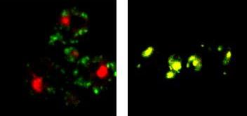 Normal (l) and Batten disease (r) model cells. Red and green fluorescent protein markers that do not co-localize in normal cells overlap in the disease cell images, indicating mis-trafficking of the green organelle marker