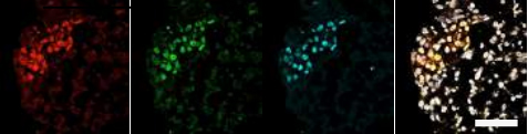 Clusters of human embryonic stem cells that were differentiated to an early germ cell (PGC) state (colored cells). Each color reveals the expression of a different gene. (l-r) NANOS3, NANOG, OCT4 and, on the right, all three combined in a single image