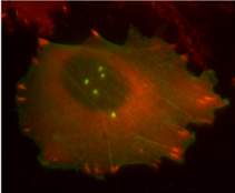 A melanoma cancer cell is labeled with invadopodia markers in fluorescence microscopy