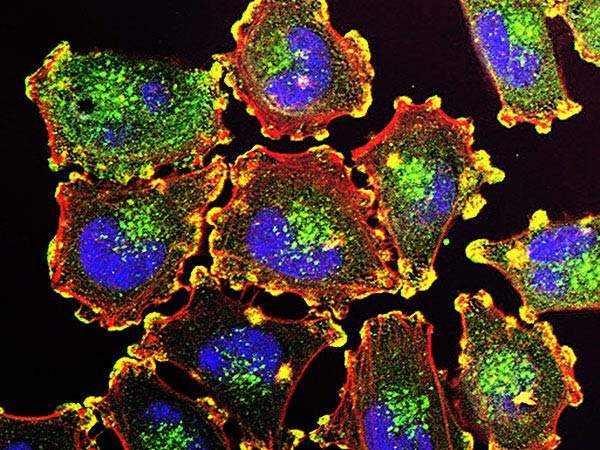  Metastatic melanoma cells. Image: NIH