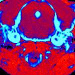 MRI brain scans of mice with Gaucher disease Type III. The scan of a mouse that received the new treatment (left) shows a significant reduction in tissue inflammation (blue) compared to an untreated mouse (right)