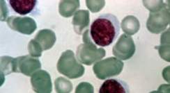  Leukemia cells. Image: Wikimedia commons, NIH