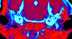 MRI brain scans of mice with Gaucher disease Type III. The scan of a mouse that received the new treatment (left) shows a significant reduction in tissue inflammation (blue) compared to an untreated mouse (right)