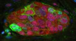 A tumor sample from a human patient with the most common type of lung cancer (adenocarcinoma). Senescent cells are highlighted by their expression of the p16 (red) and the PD-L1 (green) proteins. Cell nuclei are in blue