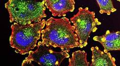  Metastatic melanoma cells. Image: NIH