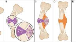 Natural healing process of fractured bones. (A) Healing begins with a collection of blood and inflammation at the fracture site. (B) Soft callus (purple) is formed, which develops into the bidirectional growth plate at the concave side of the fracture site. (C) The growth plate drives bone growth in opposite directions. The result is a jack-like mechanical effect that moves the fragments toward straightening (red arrows). (D) New bone tissue is formed (orange). (E) The shape of the bone is fine-tuned by rem