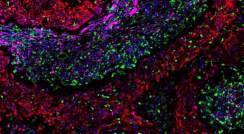 רקמת סרטן שד מהסוג טריפל-נגטיב שעברה צביעה כדי לחשוף את התאים הסרטניים (אדום) ואת שני סוגי הפיברובלסטים: pCAFs (ורוד) ו- sCAFs(ירוק). גרעיני כל התאים צבועים בכחול