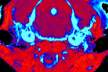 MRI brain scans of mice with Gaucher disease Type III. The scan of a mouse that received the new treatment (left) shows a significant reduction in tissue inflammation (blue) compared to an untreated mouse (right)