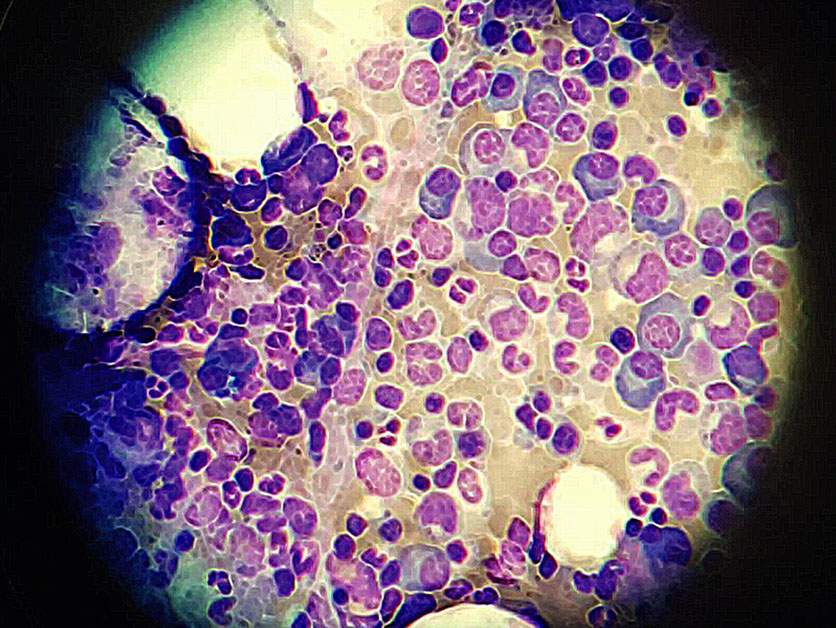 multiple myeloma drug resistant cells 