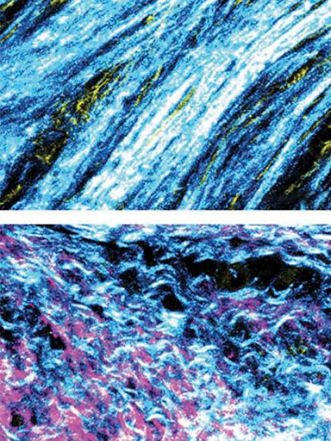 Collagen fibers deposited by fibroblasts in the tumor microenvironment, viewed under a microscope. The fibers form an orderly pattern in tumors with an unmutated BRCA gene (top); in contrast, in tumors of patients harboring BRCA mutations (bottom), the collagen structure is disordered