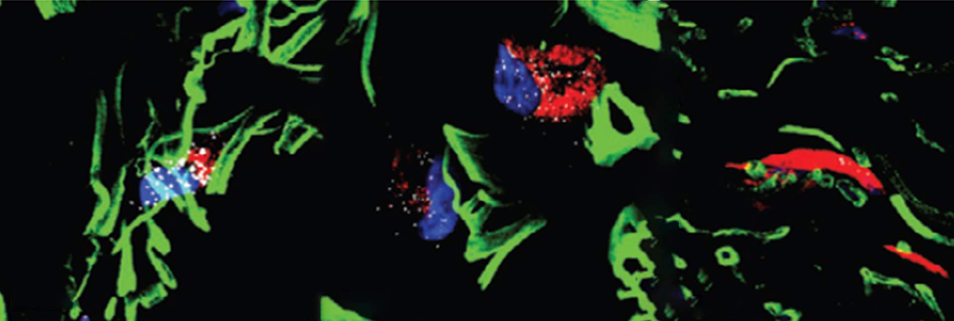 In healthy skin (left), ScAFs feature long, thin extensions (green). In patients with limited scleroderma (center), and even more so, in those with diffuse scleroderma (right), the numbers of ScAFs are reduced. They gradually lose their elongated extensions and develop altered expression levels of certain proteins (blue, red)