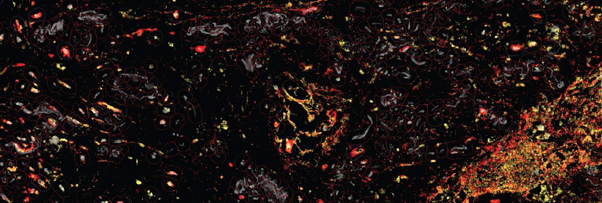 Human lung cancer tissue under a microscope. The enzymes (yellow) that unmask the immune-activating molecules are found near the TREM2 receptors (red) of the tumor-assisting macrophages. This targeted unmasking can prevent damage to healthy tissues