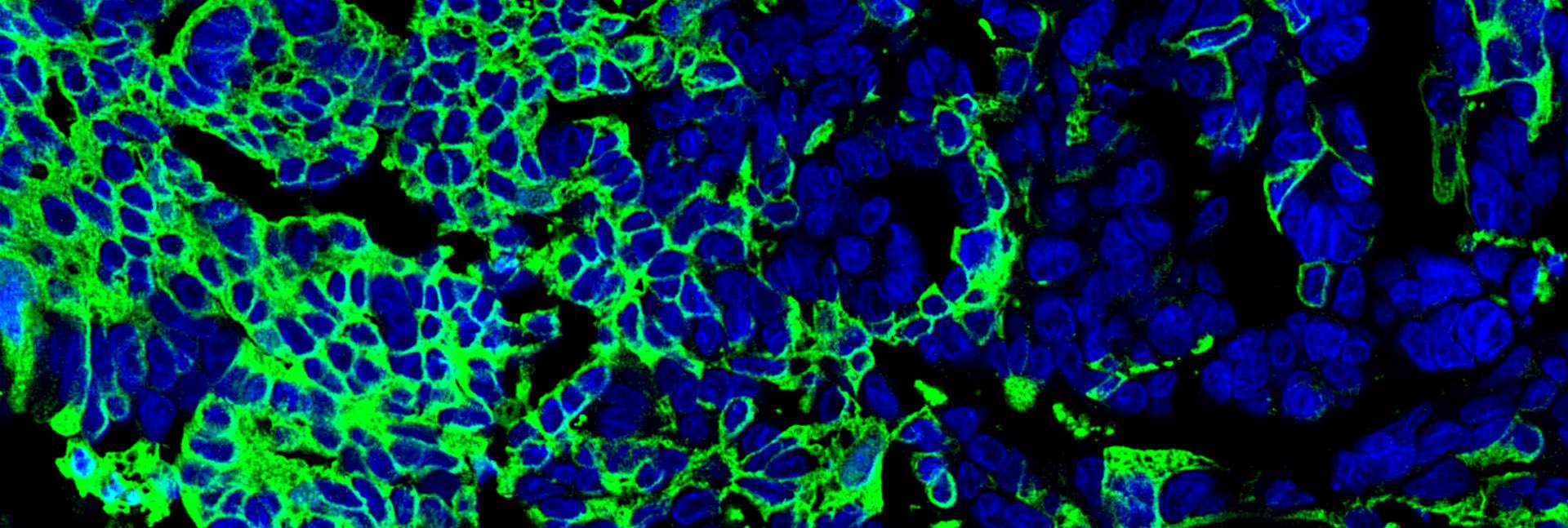 Natural anticancer antibodies (green) bound to ovarian tumor cells; the cells’ nuclei are in blue. Viewed with confocal microscopy