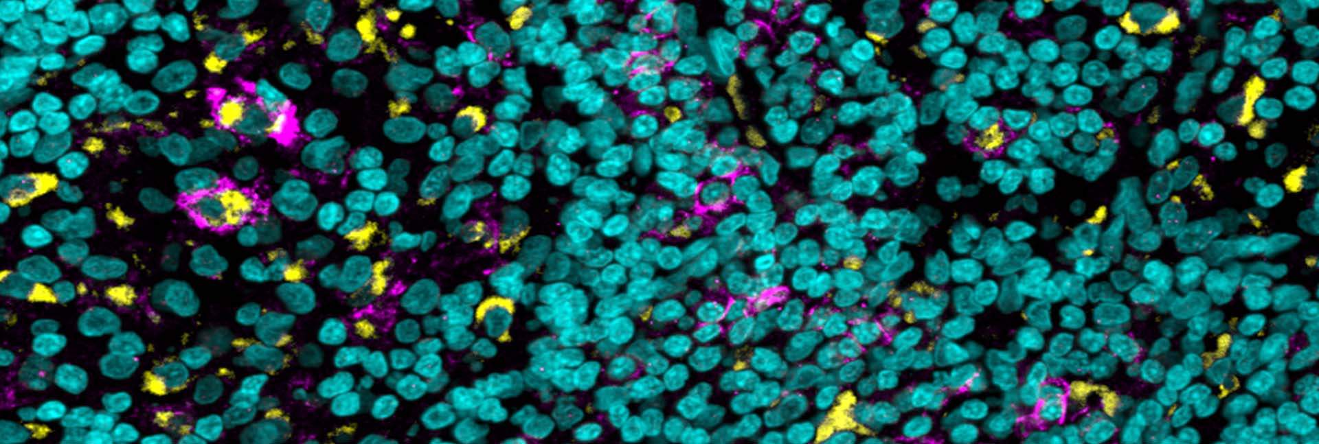Tissue sample of a particularly aggressive skin cancer reveals immune cells (yellow) that express on their surfaces a “brake pedal” receptor called FcgIIb (purple); cell nuclei are in blue