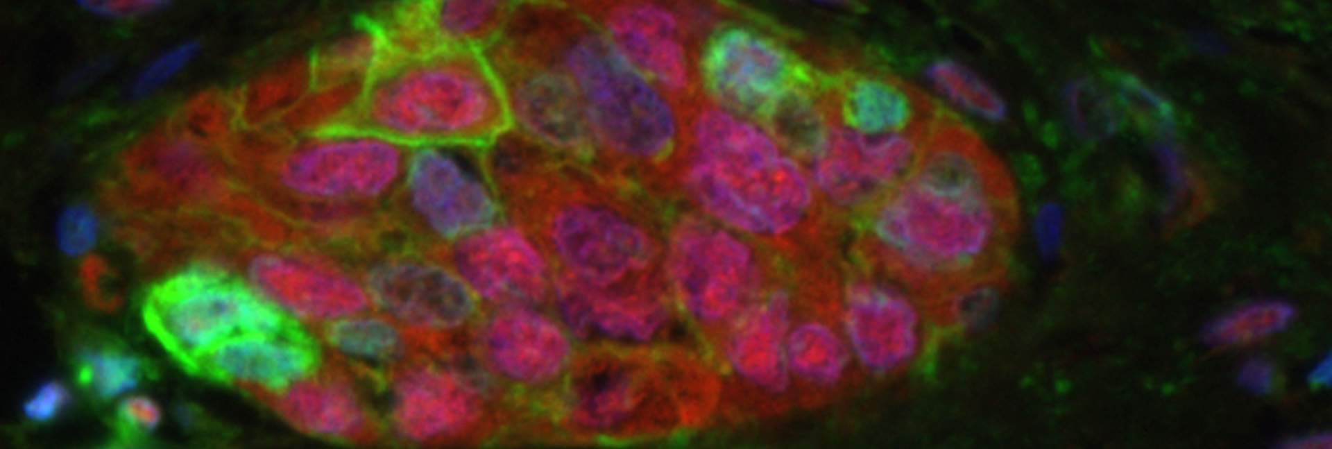 A tumor sample from a human patient with the most common type of lung cancer (adenocarcinoma). Senescent cells are highlighted by their expression of the p16 (red) and the PD-L1 (green) proteins. Cell nuclei are in blue