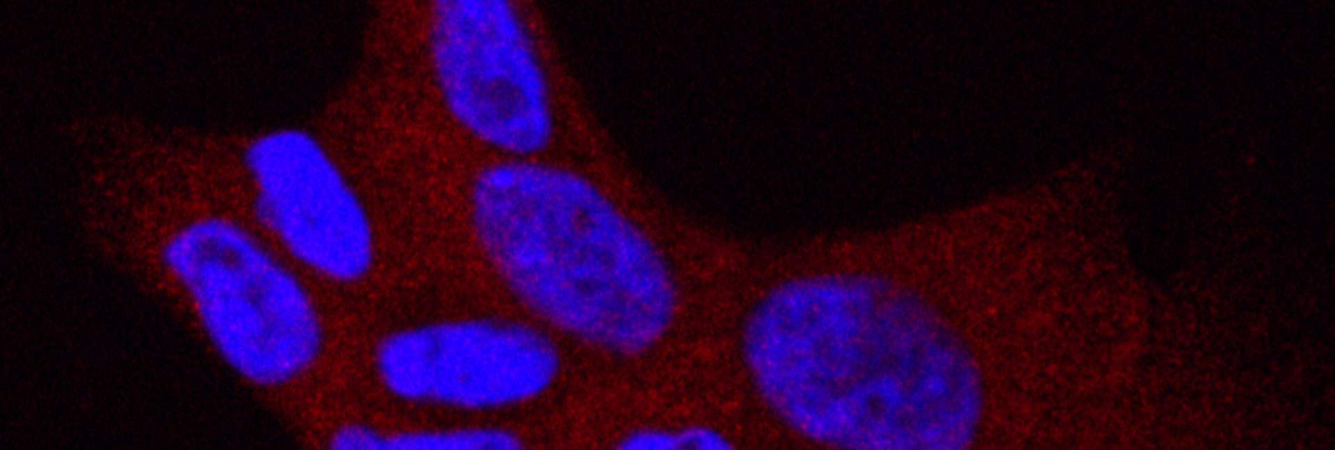 Human lung cancer cells harboring the L858R mutation in the EGFR gene. Cell nuclei are in blue. The red color marks a protein that is present in the cell cytoplasm when the EGFR is active and driving the uncontrolled cell divisions