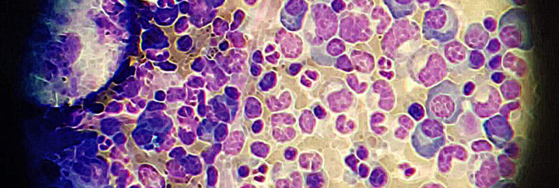 multiple myeloma drug resistant cells 